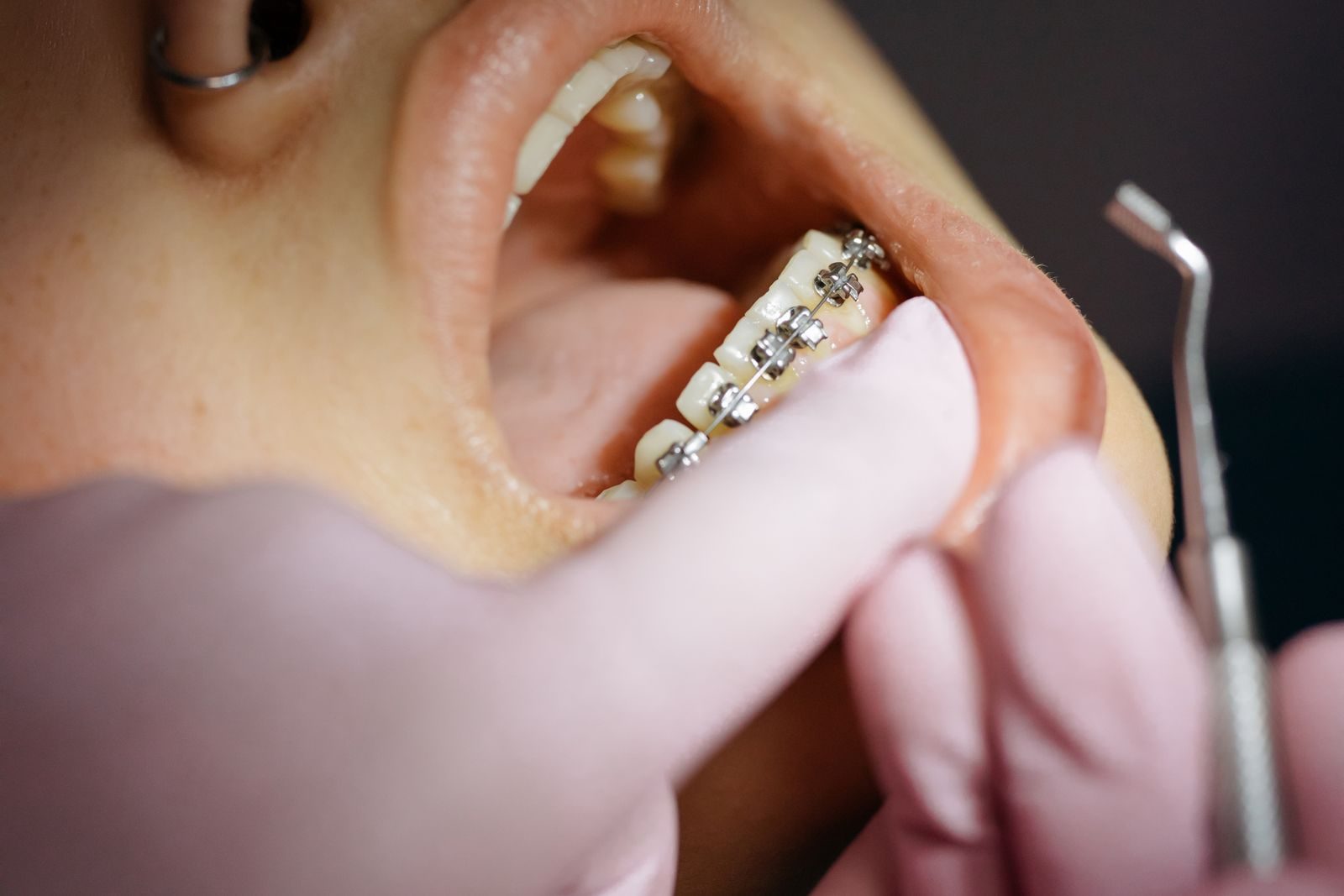 Orthodontist's gloved hands examining the braces on a patient's upper teeth
