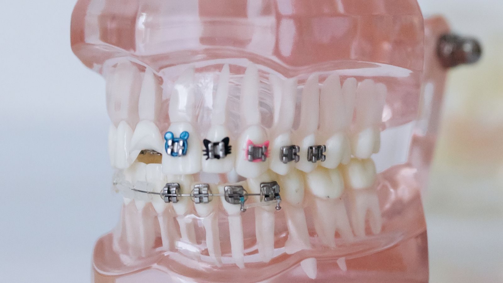 Orthodontic teaching model of teeth fitted with coloured brackets and wires