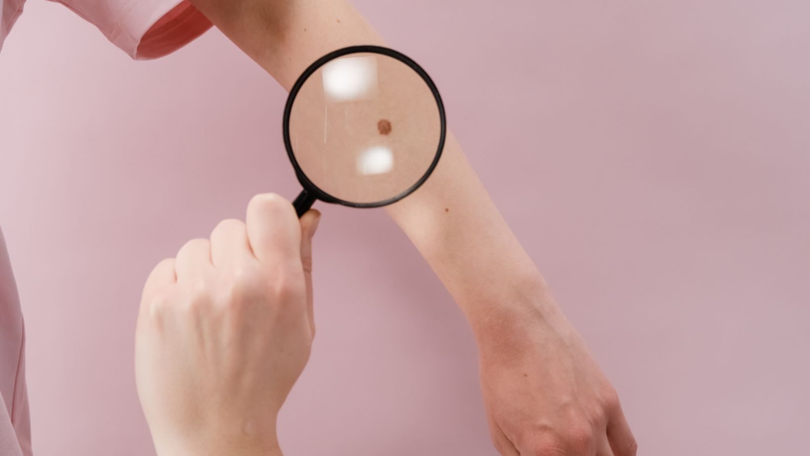 Clinician examining a mole on a forearm through a magnifying glass